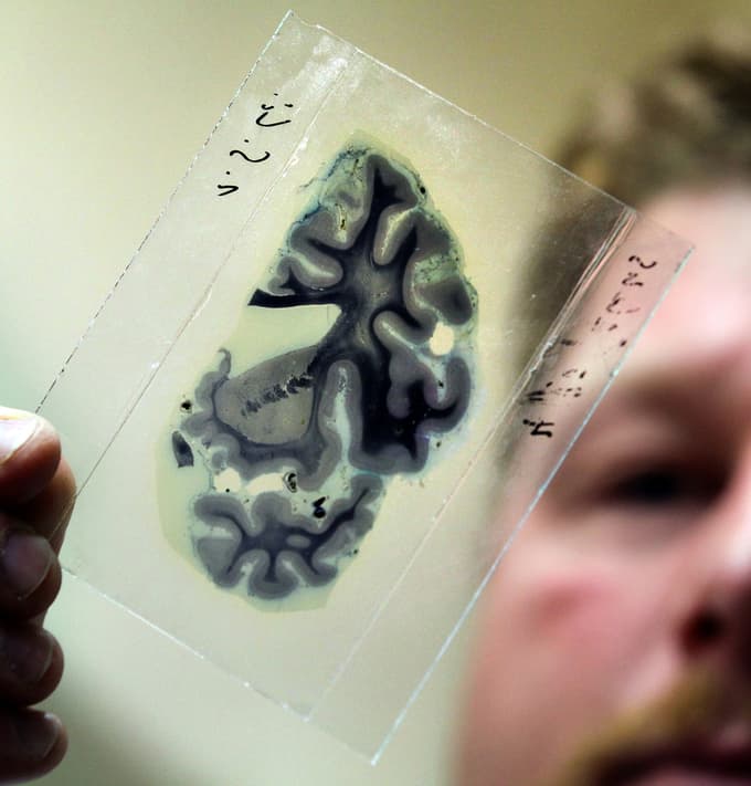 Alzheimer ostaja uganka. Foto: Epa