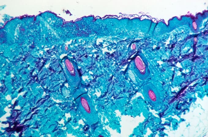 Mikroskopski posnetek vzorca opičje kože, ki je okužena z virusom opičjih koz.