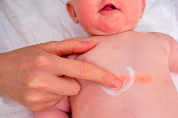 Plenični izpuščaj: Moč ga je preprečiti, a nikar ne počnite teh napak ...