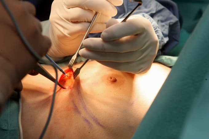 23. januar 2007, Maribor, Splošna bolnišnica Maribor, oddelek za plastično kirurgijo - Lepotna operacija na dojkah