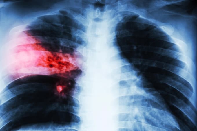 Lobar pneumonia. film chest x-ray show alveolar infiltration at right middle lobe due to tuberculosis infection.,Image: 316223378, License: Royalty-free, Restrictions:, Model Release: no