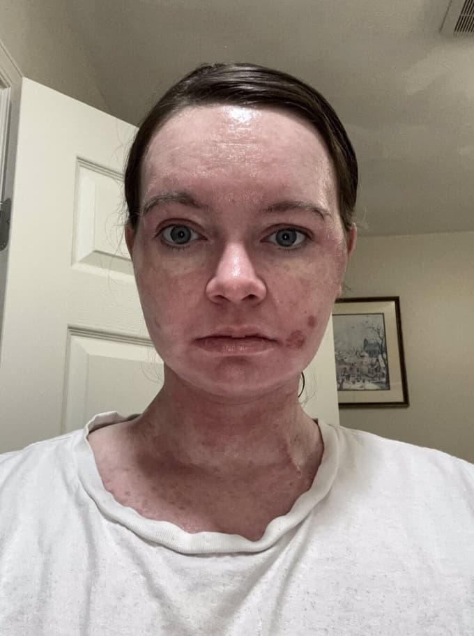 Že po 15 sekundah izpostavljenosti ultravijoličnim žarkom njena koža dobesedno gori. Na telesu se ji takoj pojavijo izpuščaji in mehurji, koža pa se včasih celo začne lupiti.