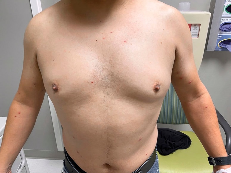 Posledice okužbe z opičjimi kozami