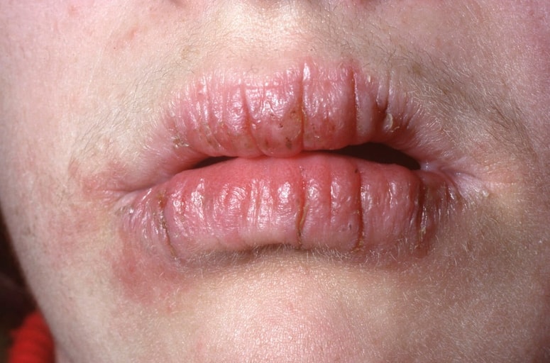 Ste kdaj opazili boleče razpoke v kotičkih ustnic, ki se nočejo in nočejo zaceliti?